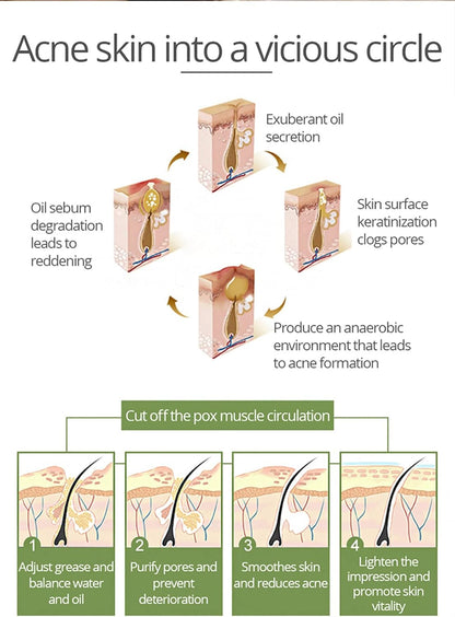 Aichun Beauty Anti-Acne Whitening Facial Serum – 30ml - Product Image 6